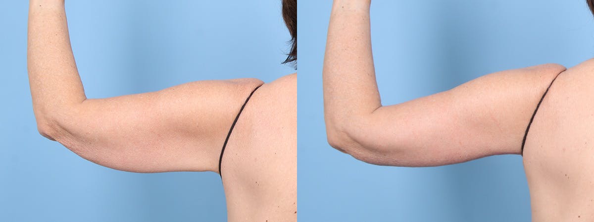 Arm Lift (Brachioplasty) Before & After Gallery - Patient 297785 - Image 3