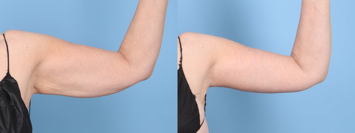 Arm Lift (Brachioplasty) Before & After Gallery - Patient 297785 - Image 2