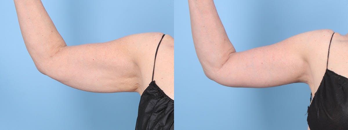 Arm Lift (Brachioplasty) Before & After Gallery - Patient 297785 - Image 4