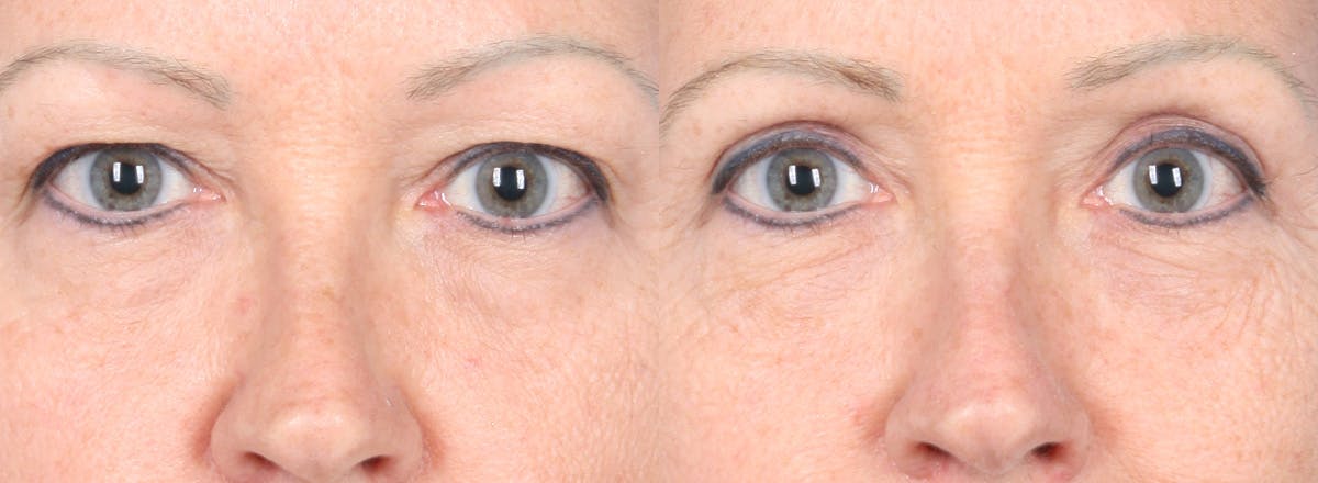 Eyelid Surgery Before & After Gallery - Patient 385304 - Image 1