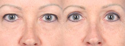 Eyelid Surgery Before & After Gallery - Patient 385304 - Image 1
