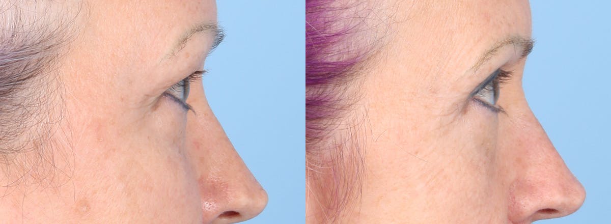 Eyelid Surgery Before & After Gallery - Patient 385304 - Image 4