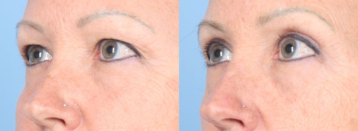 Eyelid Surgery Before & After Gallery - Patient 385304 - Image 2
