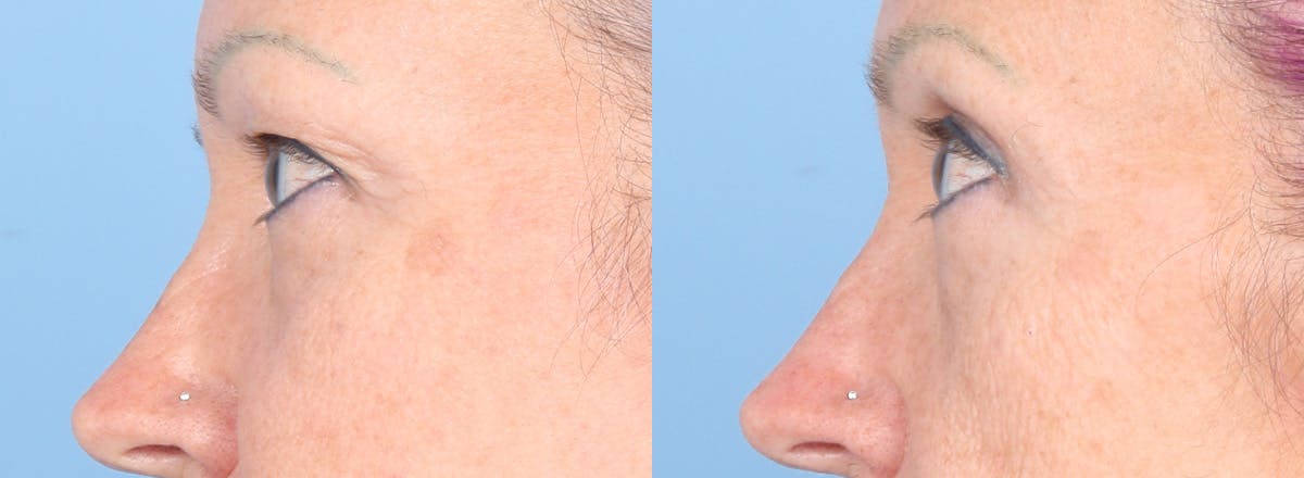 Eyelid Surgery Before & After Gallery - Patient 385304 - Image 3