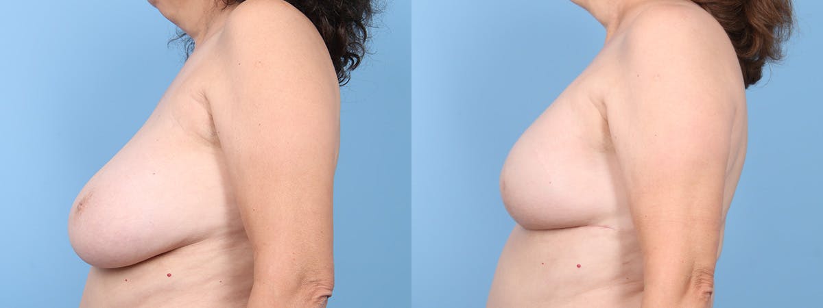 Direct to Implant Reconstruction Before & After Gallery - Patient 428934 - Image 5