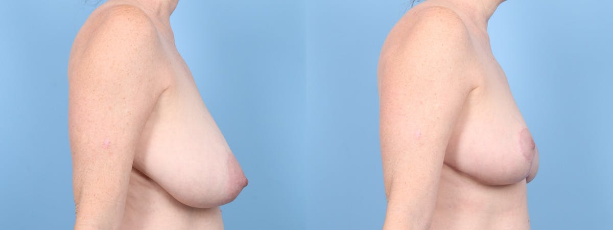Breast Reduction/Lift Before & After Gallery - Patient 197575 - Image 3