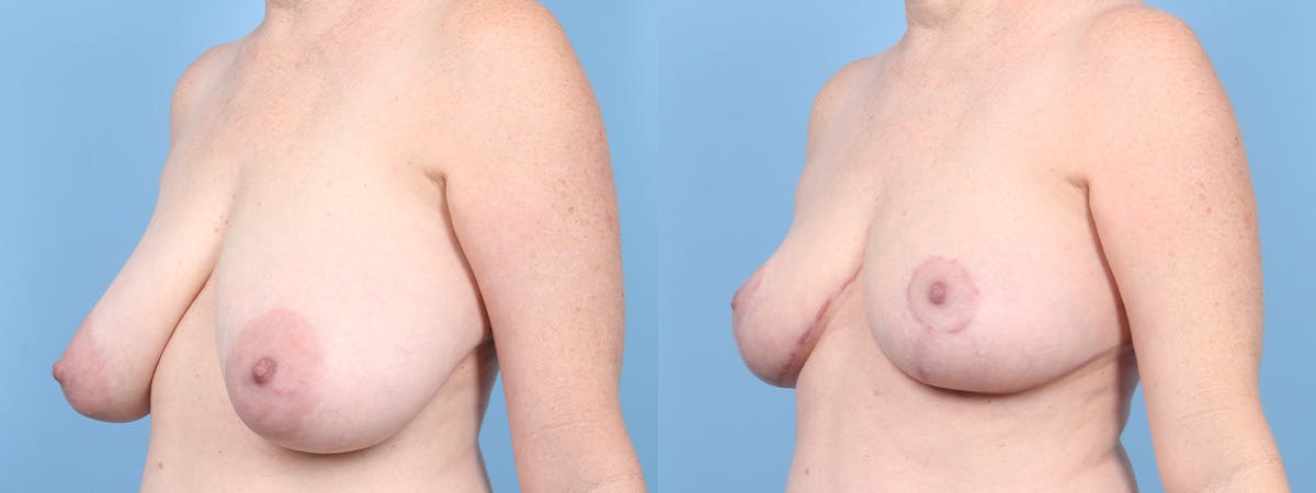 Breast Reduction/Lift Before & After Gallery - Patient 197575 - Image 4