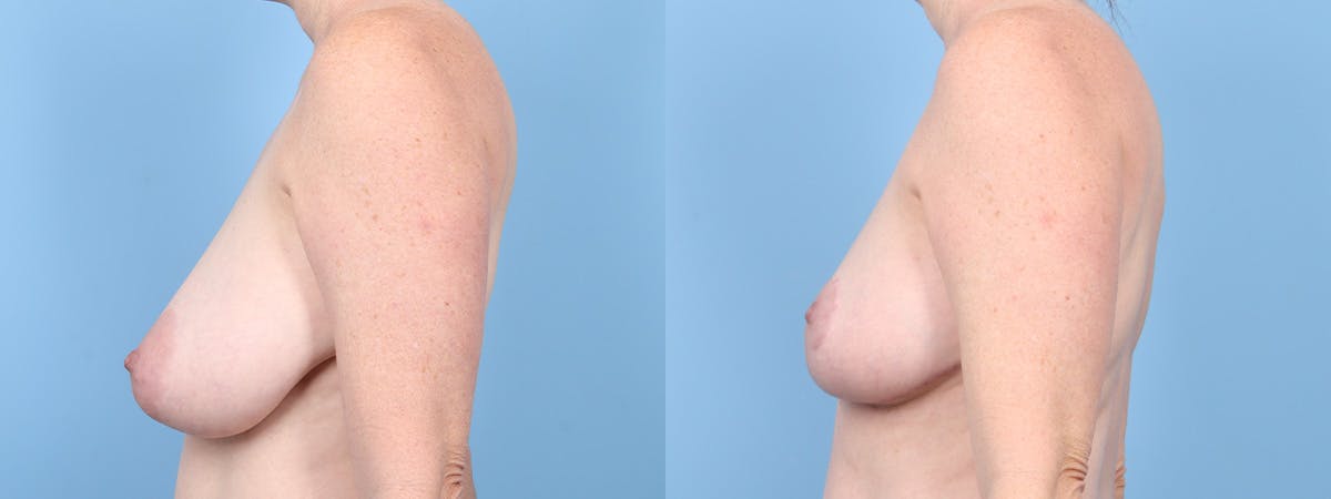 Breast Reduction/Lift Before & After Gallery - Patient 197575 - Image 5
