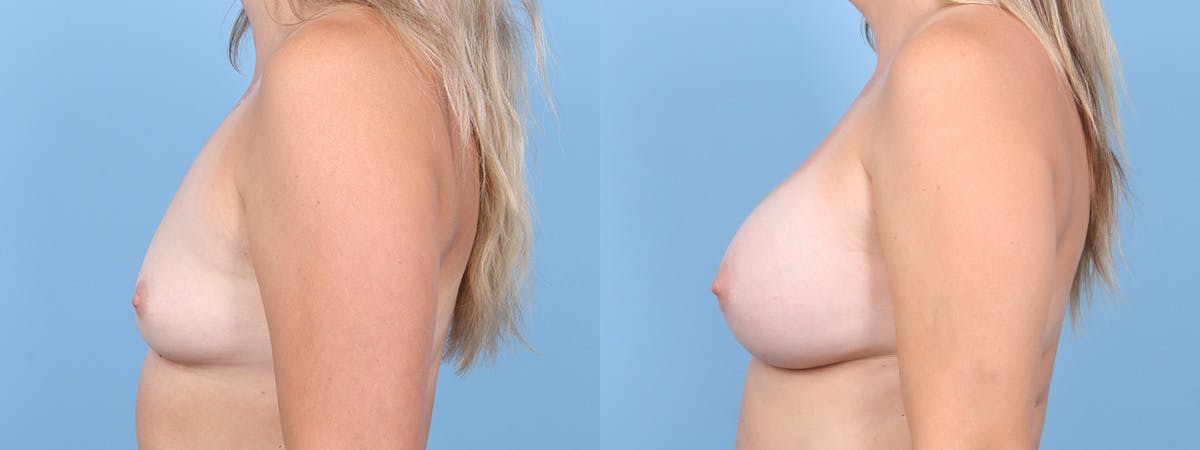 Breast Augmentation Before & After Gallery - Patient 345656 - Image 5