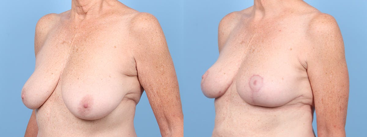 Breast Reduction/Lift Before & After Gallery - Patient 211201 - Image 4