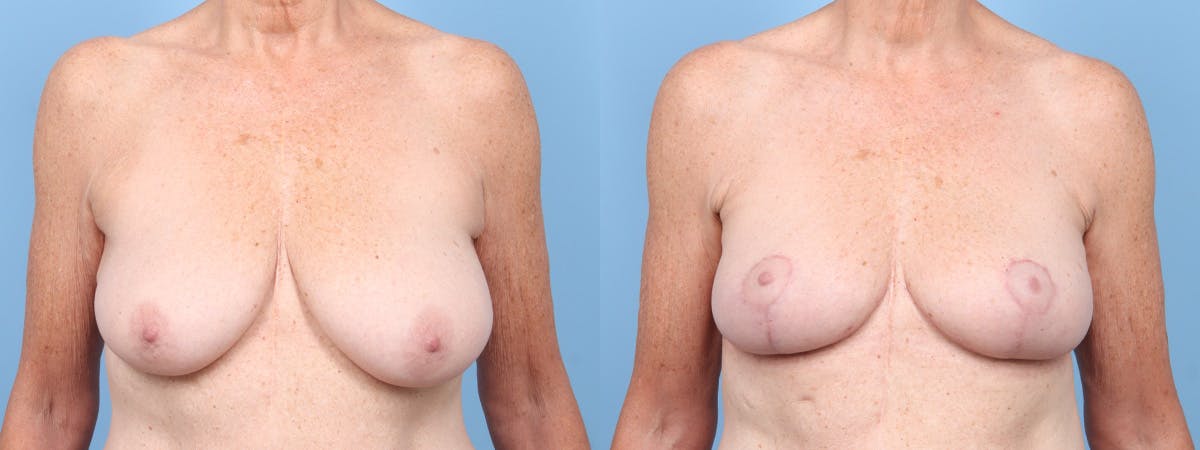 Breast Reduction/Lift Before & After Gallery - Patient 211201 - Image 1