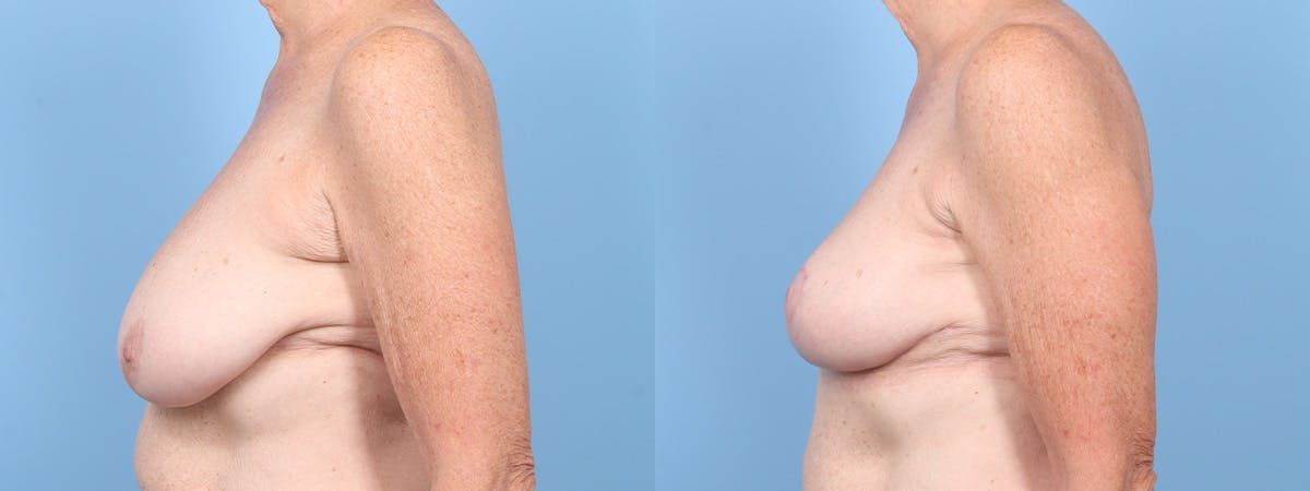 Breast Reduction/Lift Before & After Gallery - Patient 211201 - Image 5
