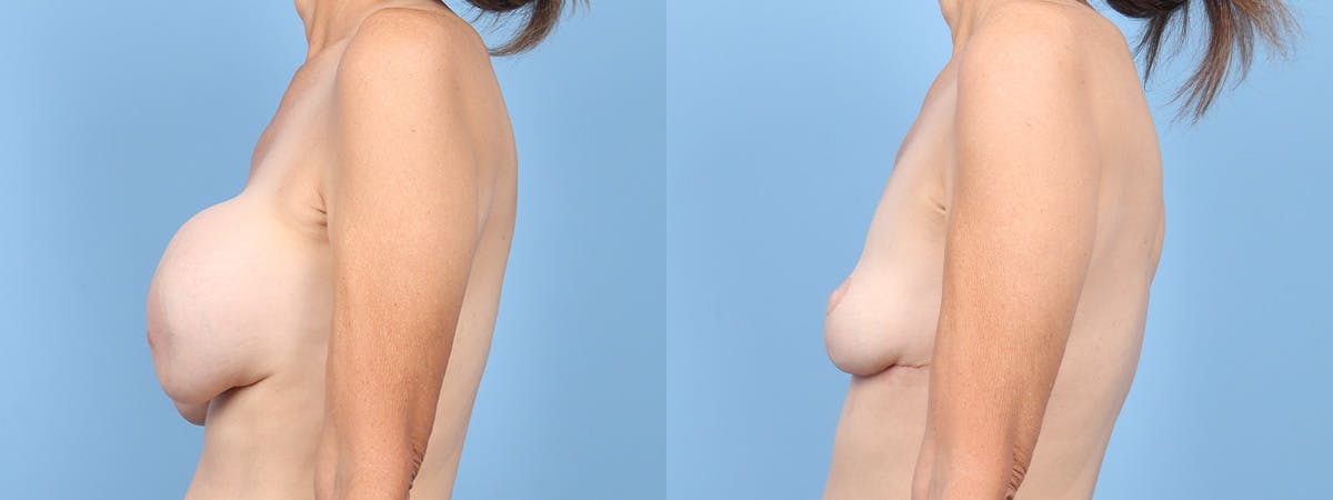 Implant Removal Before & After Gallery - Patient 141650 - Image 5