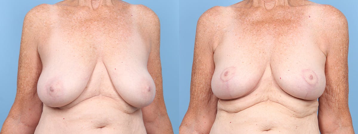 Breast Reduction/Lift Before & After Gallery - Patient 354685 - Image 1