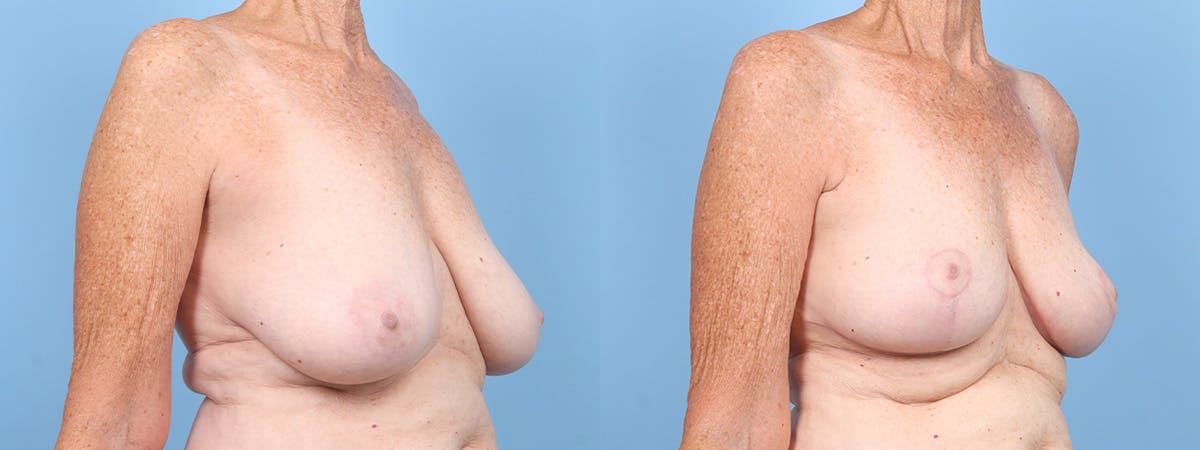 Breast Reduction/Lift Before & After Gallery - Patient 354685 - Image 2