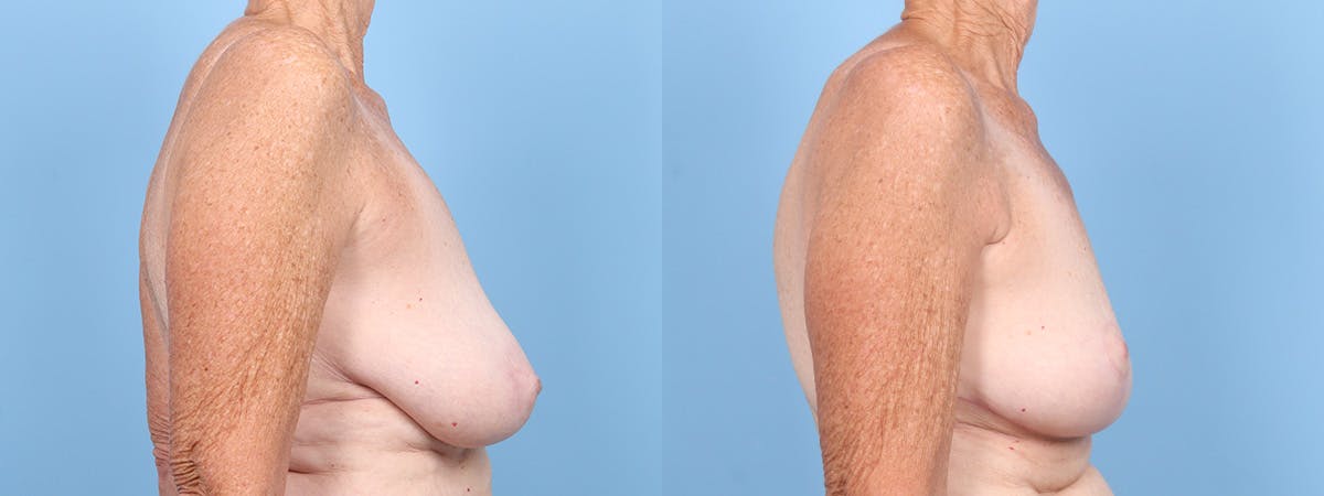 Breast Reduction/Lift Before & After Gallery - Patient 354685 - Image 3