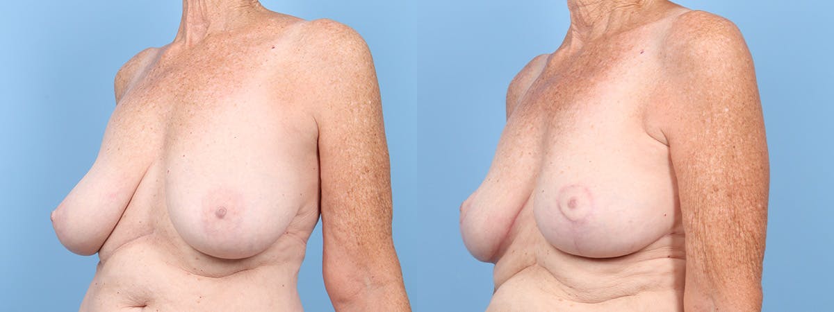 Breast Reduction/Lift Before & After Gallery - Patient 354685 - Image 4