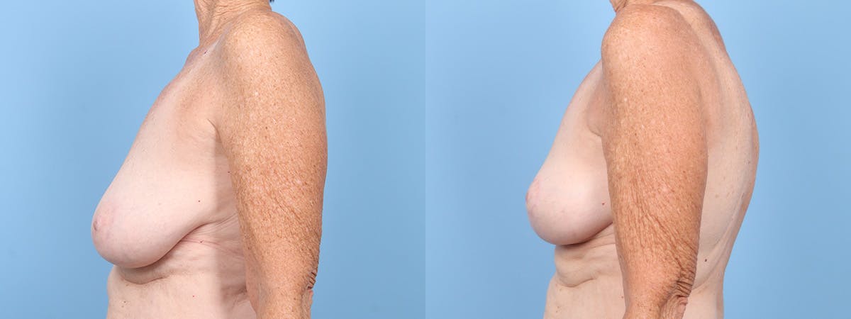 Breast Reduction/Lift Before & After Gallery - Patient 354685 - Image 5