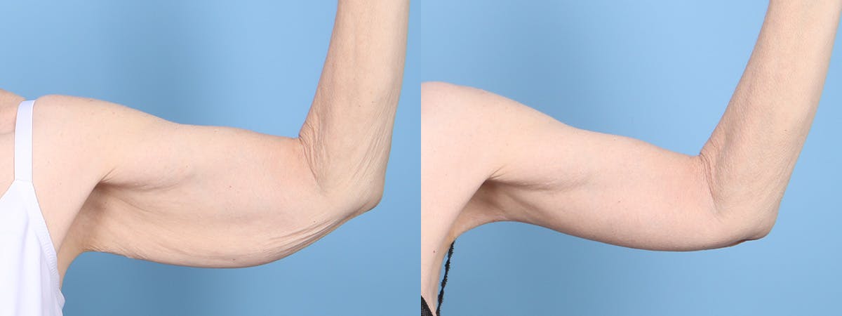 Arm Lift (Brachioplasty) Before & After Gallery - Patient 408942 - Image 2