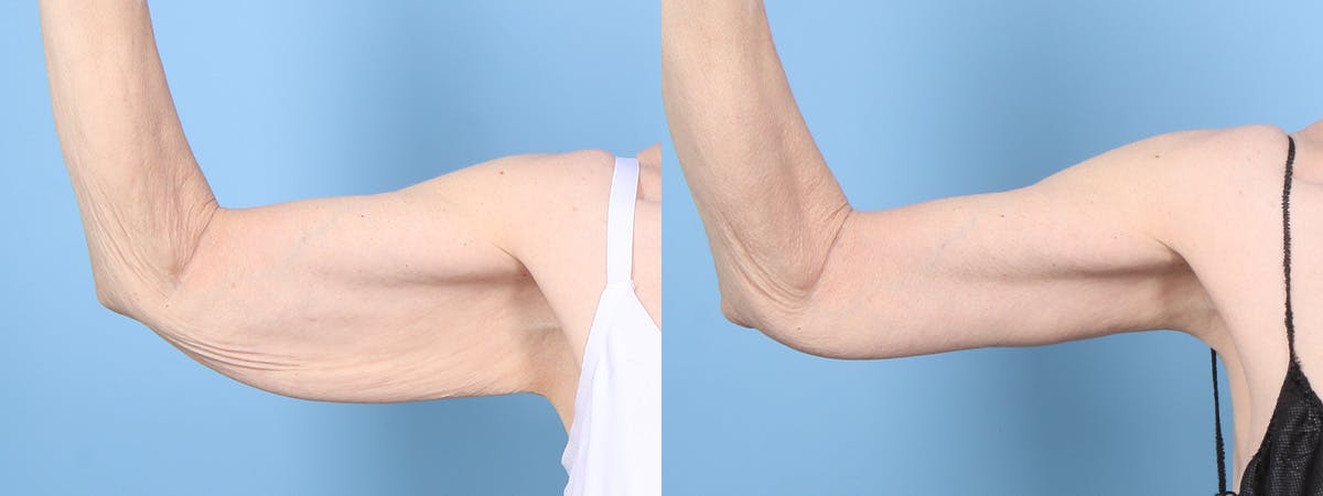 Arm Lift (Brachioplasty) Before & After Gallery - Patient 408942 - Image 4