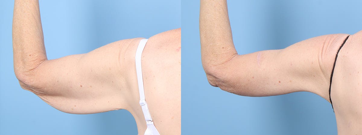 Arm Lift (Brachioplasty) Before & After Gallery - Patient 408942 - Image 3