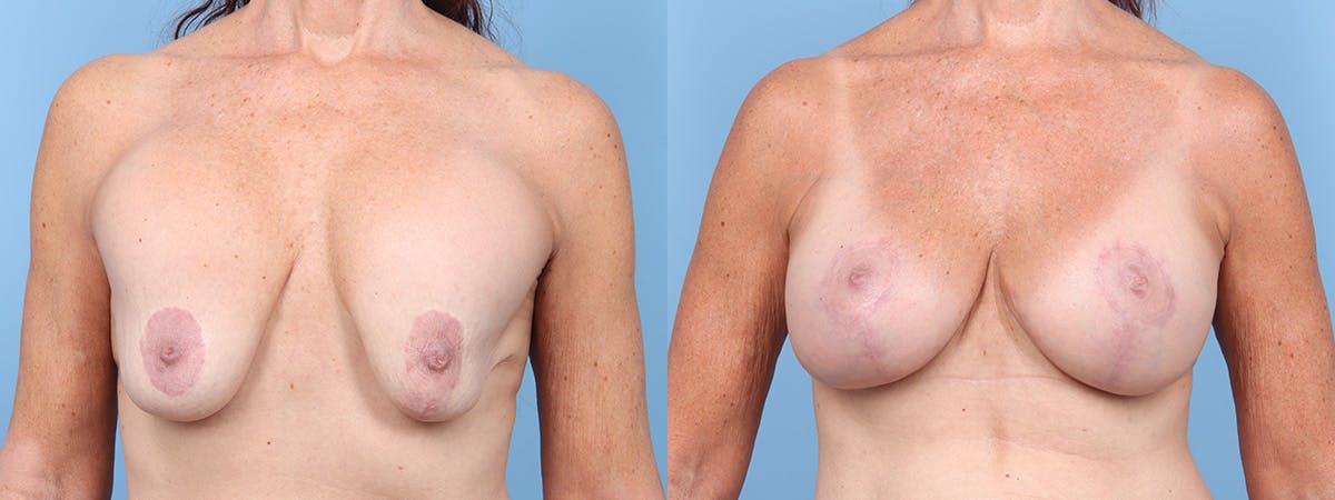 Implant Revision Before & After Gallery - Patient 288317 - Image 1