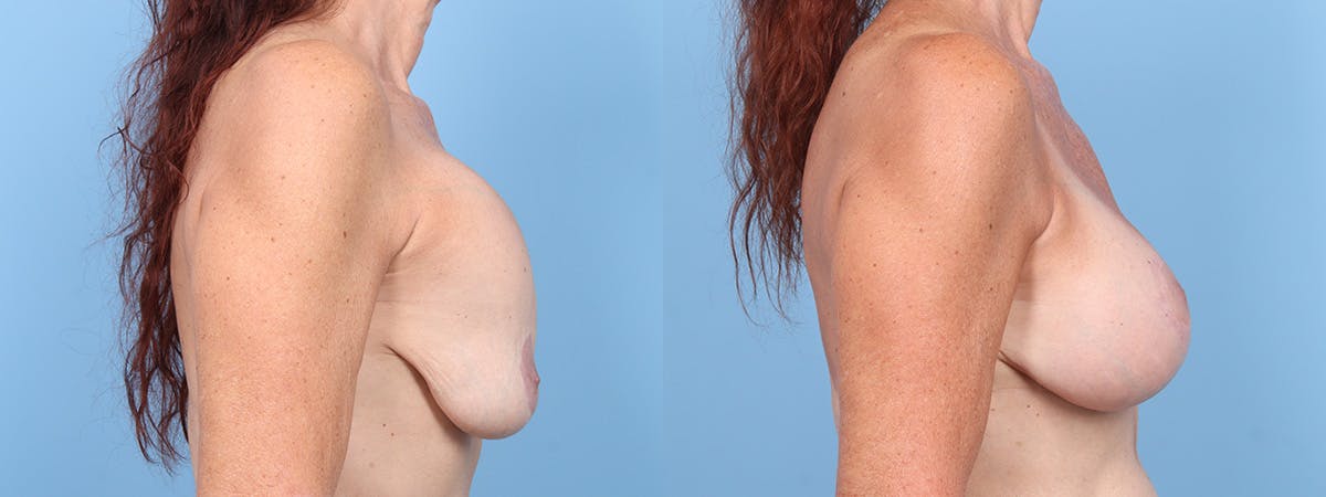 Implant Revision Before & After Gallery - Patient 288317 - Image 3