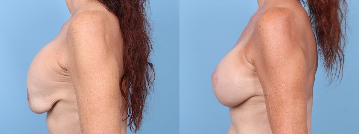 Implant Revision Before & After Gallery - Patient 288317 - Image 5