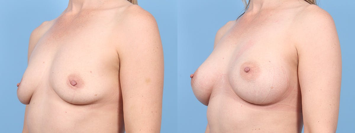 Breast Augmentation Before & After Gallery - Patient 371501 - Image 4
