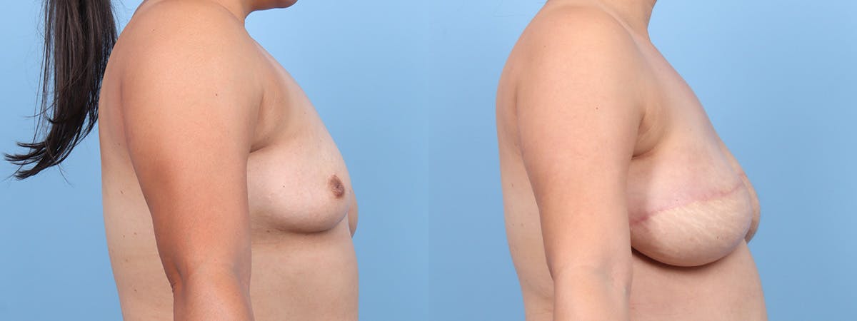 DIEP Flap Reconstruction Before & After Gallery - Patient 155712 - Image 3