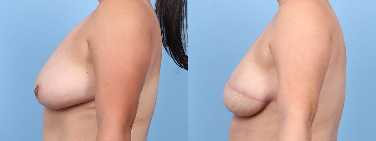 DIEP Flap Reconstruction Before & After Gallery - Patient 155712 - Image 5