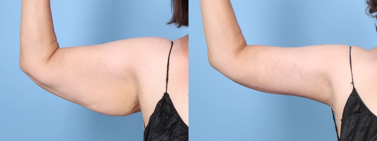 Arm Lift (Brachioplasty) Before & After Gallery - Patient 201151 - Image 4