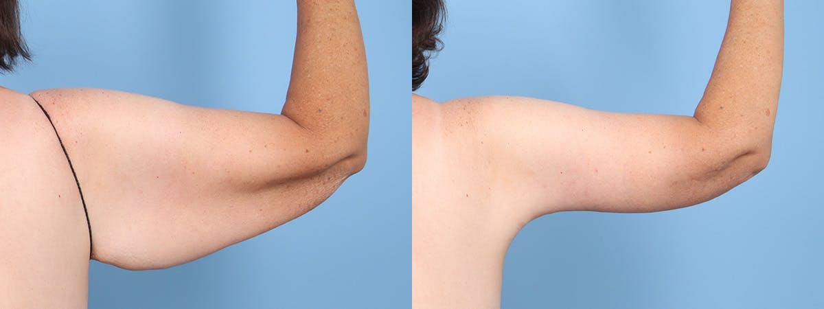 Arm Lift (Brachioplasty) Before & After Gallery - Patient 201151 - Image 2