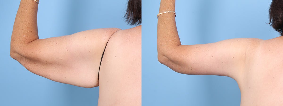 Arm Lift (Brachioplasty) Before & After Gallery - Patient 201151 - Image 3