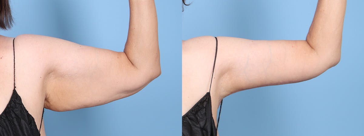 Arm Lift (Brachioplasty) Before & After Gallery - Patient 201151 - Image 1