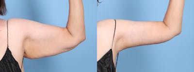 Arm Lift (Brachioplasty) Before & After Gallery - Patient 201151 - Image 1