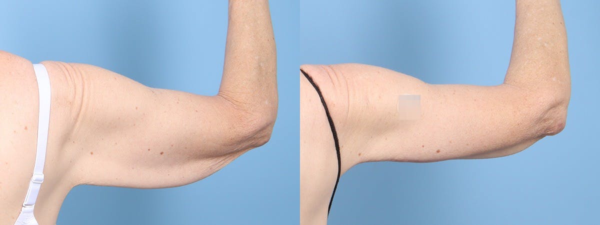 Arm Lift (Brachioplasty) Before & After Gallery - Patient 408942 - Image 1