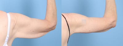 Arm Lift (Brachioplasty) Before & After Gallery - Patient 408942 - Image 1