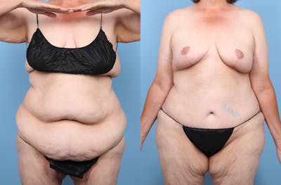 Tummy Tuck Before & After Gallery - Patient 191946 - Image 1