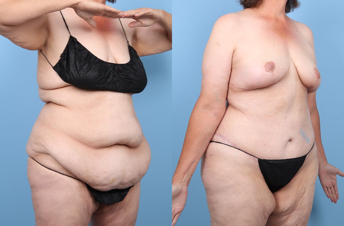 Tummy Tuck Before & After Gallery - Patient 191946 - Image 2