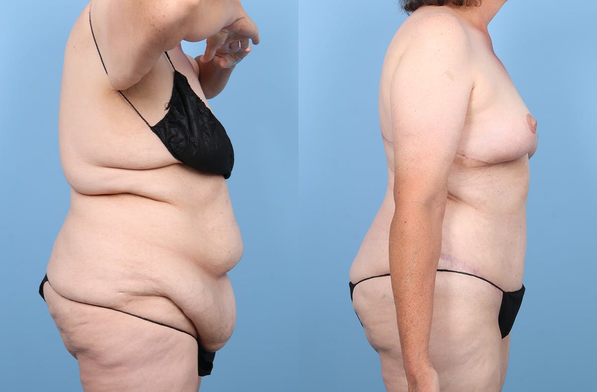 Tummy Tuck Before & After Gallery - Patient 191946 - Image 3