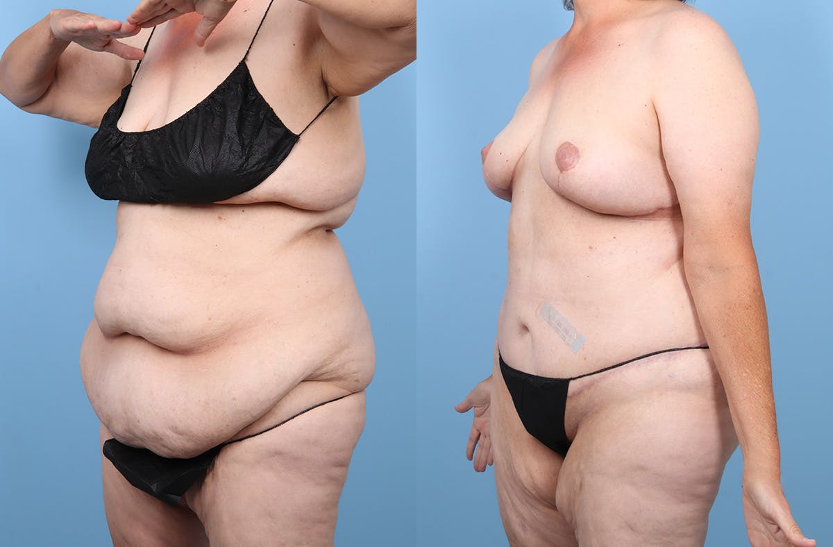 Tummy Tuck Before & After Gallery - Patient 191946 - Image 4