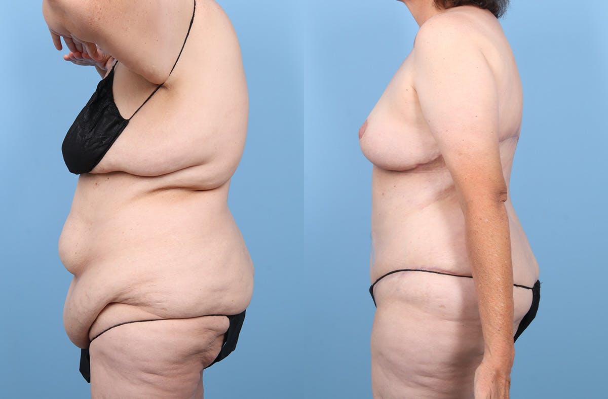 Tummy Tuck Before & After Gallery - Patient 191946 - Image 5