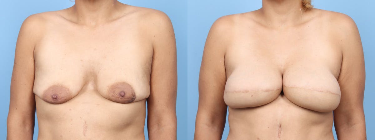 DIEP Flap Reconstruction Before & After Gallery - Patient 220332 - Image 1