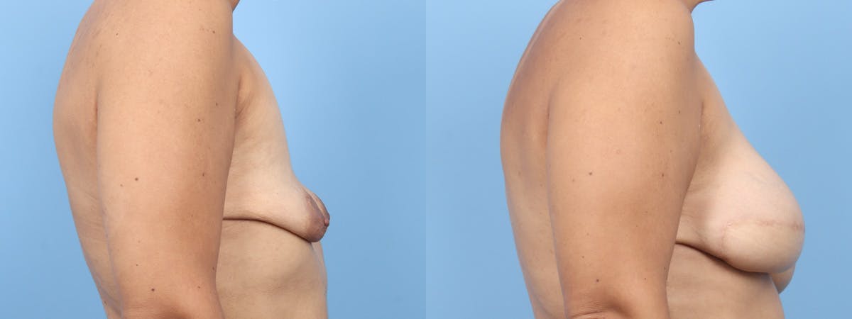 DIEP Flap Reconstruction Before & After Gallery - Patient 220332 - Image 3