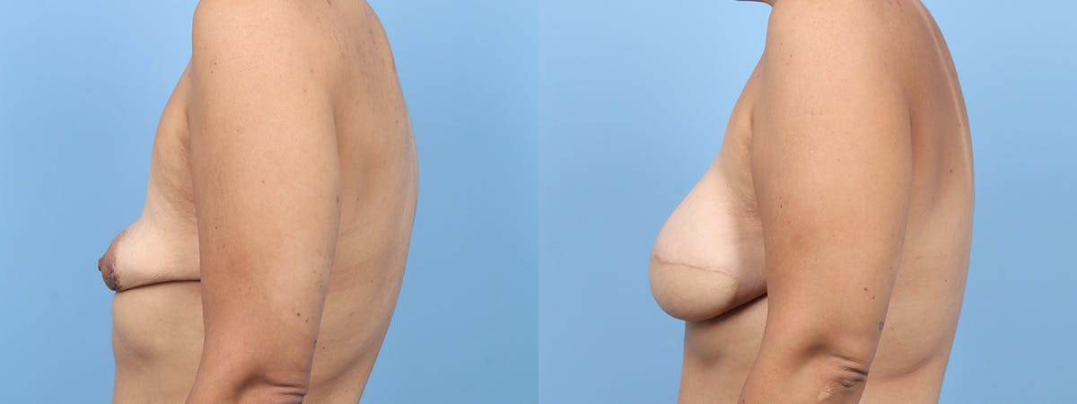 DIEP Flap Reconstruction Before & After Gallery - Patient 220332 - Image 5