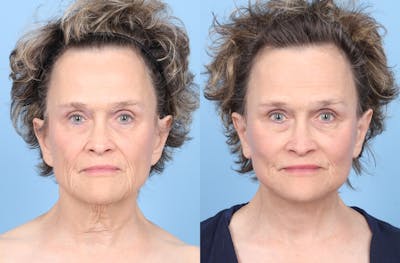 Midface Lift Before & After Gallery - Patient 306535 - Image 1