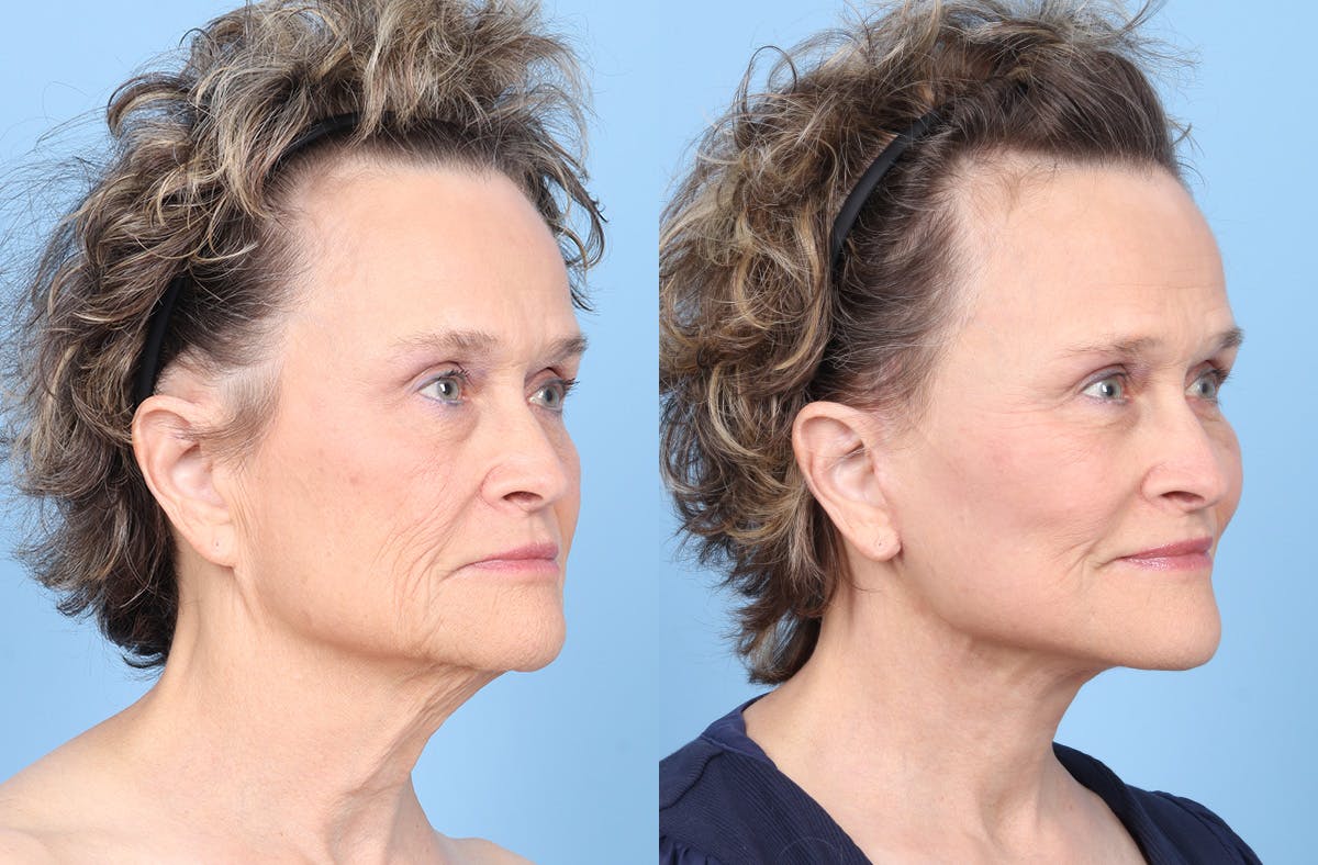 Midface Lift Before & After Gallery - Patient 306535 - Image 2