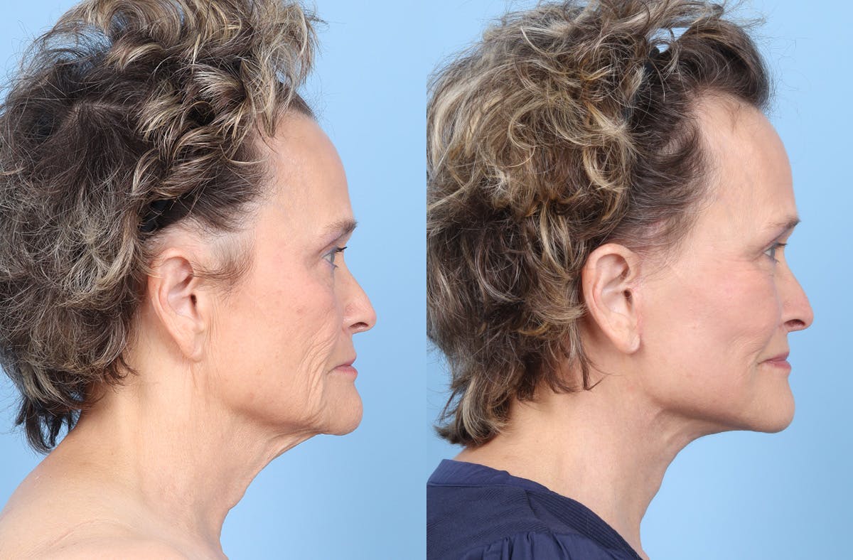 Midface Lift Before & After Gallery - Patient 306535 - Image 3