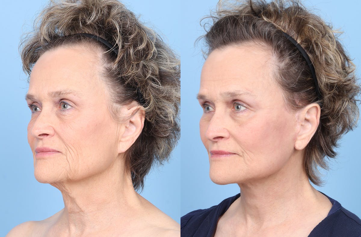 Midface Lift Before & After Gallery - Patient 306535 - Image 4